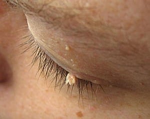 How to Get Rid of White Skin Tags on Eyelids