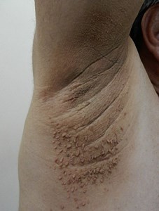 Raised Skin Bump: 31 Causes, Photos, & Treatments