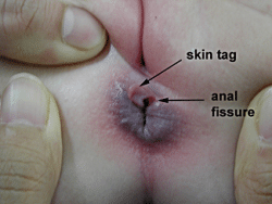 anal skin tags
