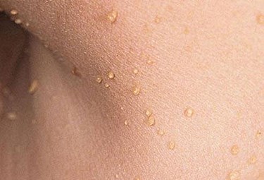 Cutting skin tags anywhere on the body