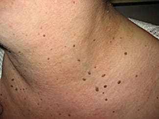 How to get rid of skin tags on neck