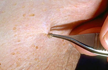 Safe way to remove skin tags on the neck