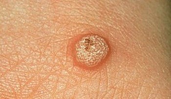 Warts on the penile shaft and cysts
