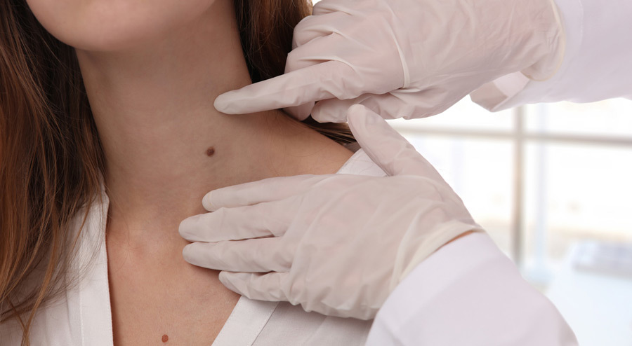 Skin Tag Removal Dermatologist Recommendations