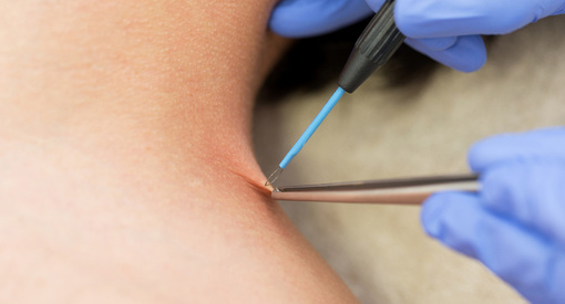 Will Your Health Insurance Cover Skin Tag Removal