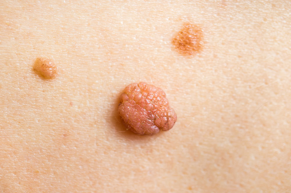 Inflamed Skin Tag - What Can Be Done About It