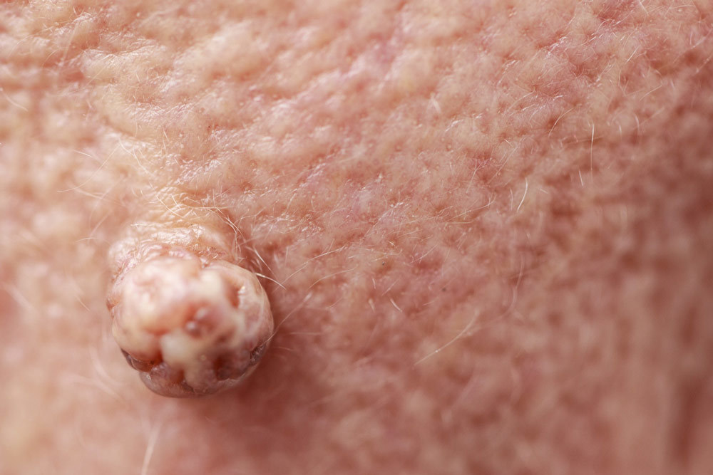 Sentinel Skin Tag Removal, Recovery, and Prevention