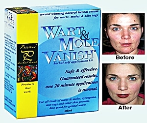 Review of Pristine wart and mole vanish