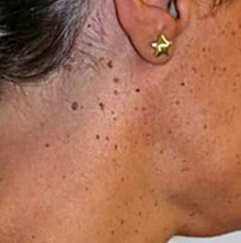 How to Remove Skin Tags on the Face
