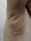 skin tag under armpit