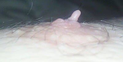 skin tag on nipple