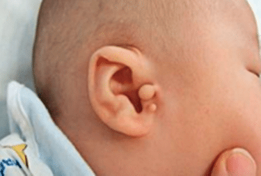 What Are Skin Tags on the Ear at Birth?
