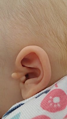 skin tags on newborn babies removal techniques