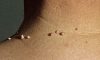 What are the best natural ways to remove skin tags on neck?