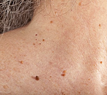 Finding the best skin tags on neck removal methods