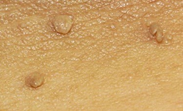 What To Do About Skin Tags That Itch