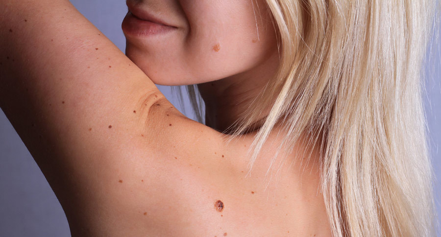 What Do Skin Tags Look Like? Understanding the Difference Between ...